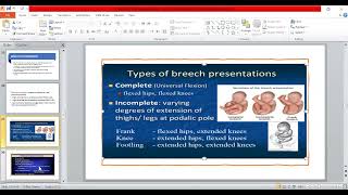 7B Malpositions amp Malpresentation part2  OBG [upl. by Assenaj]