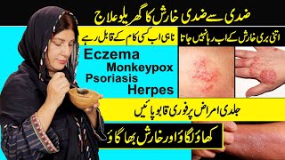 How to Treat Skin Allergies at Home  Eczema  Psoriasis  Monkeypox  Kharish Ka Fori Ilaj [upl. by Apthorp]