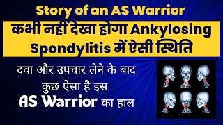 Ankylosing Spondylitis Patient Stories  Ankylosing Spondylitis Patient With Rare Symptoms  HLA B27 [upl. by Vickie]