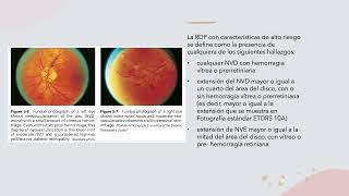 RETINOPATIA DIABETICA Y COREORETINOPATIA SEROSA CENTRAL [upl. by Vincenta]