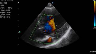 6 Year Old Dog With Subaortic Stenosis  3 TrivialAR [upl. by Greer]