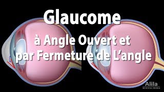 Pathologie du Glaucome Animation [upl. by Waylan]