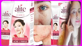 Alite Anti Acne And Pimple Gel cream review Fill all open pores [upl. by Ilhsa942]