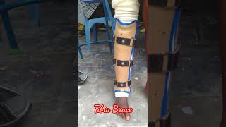 Tibia Brace [upl. by Willis]