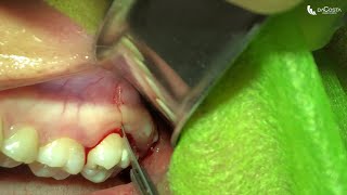 Exodontia de terceiro molar superior Upper wisdom tooth extraction [upl. by Lirrehs]