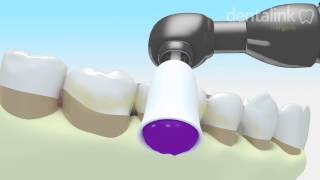 LIMPIEZA periodontal supragingival Sarro dental  Video 3D [upl. by Gurolinick]