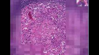 Histopathology Lymph node Tuberculosis [upl. by Gnurt]