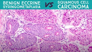 Eccrine Syringometaplasia  benign reactive mimic of squamous cell carcinoma dermpath pathology [upl. by Fernas]