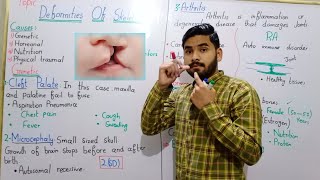 Deformities Of Skeleton By Hadi  Cleft Palate Microcephaly Osteoporosis Class 12 In Urdu Hindi [upl. by Ahselrac]