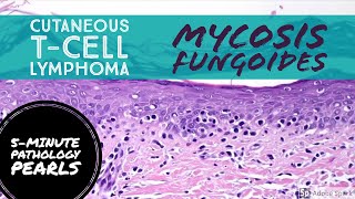 Mycosis Fungoides Cutaneous TCell Lymphoma 5Minute Pathology Pearls [upl. by Eppillihp]