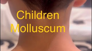 Children Molluscum treatment Don’t worry Just Don’t manipulate and scratch or cryo or acid [upl. by Tasia]