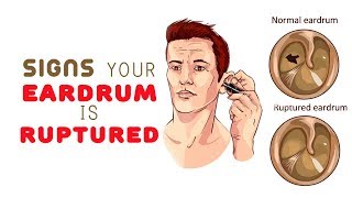 8 Signs Your Eardrum is Ruptured [upl. by Yaj607]