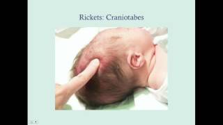 Rickets  CRASH Medical Review Series [upl. by Lyret]