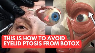 Avoid Eyelid Ptosis From Botox Treatments with THIS Anatomy Knowledge [upl. by Netsryk721]