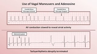 Intro to EKG Interpretation  How to Identify Any Tachyarrhythmia with 6 Easy Questions [upl. by Lotsirb573]