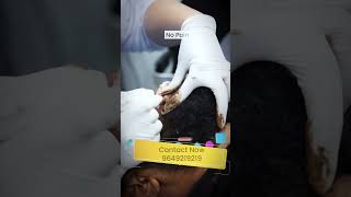 Treatment of White Patches  Vitiligo  Safed Daag by Micro pigmentation technique shorts skinaa [upl. by Okkin]