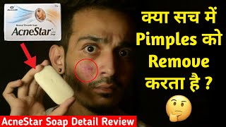 क्या AcneStar Soap सच में Acne Pimples को Remove करता है  Detail Review Uses Benefit Side Effect [upl. by Annauj]