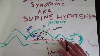 EMT Supine Hypotension  EMT MADE EASY [upl. by Donia288]