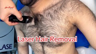 Laser Hair Removal Peshawar and Pakistan [upl. by Narud]