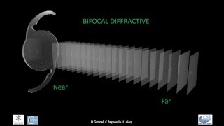 Comparison of 3 Diffractive IOLs in 3 Wavelengths Bifocal EDOFTrifocal [upl. by Shoshana470]