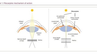 Using Muscarinic Agonist drugs Pilocarpine to treat Glaucoma [upl. by Nyre152]