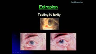 A Class On Ectropion By Dr VivekanandDept Of Ophthalmology [upl. by Zobe528]