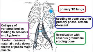 TB osteomyelitis skill lab [upl. by Enyrehtac96]