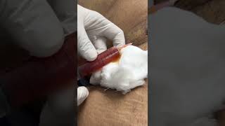 Seroma after Liposuction Aspiration of Seroma Fluid [upl. by Atews]