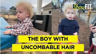 Boy With Rare Condition Turns Into An Internet Sensation What is the Uncombable Hair Syndrome [upl. by Nawram]