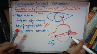 EXTRACAPSULAR CATARACT EXTRACTION PART 2 FSL and manual extraction made easy [upl. by Thamos]