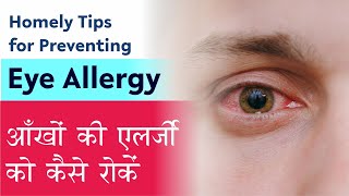 Eye Allergy Treatment Easy tips from Eye surgeon to manage Eye Allergy आंखों में जलन का आसान इलाज [upl. by Huoh]