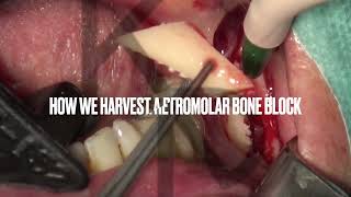 How we harvest a retromolar bone block with the Microsaw in only 1’34’’ [upl. by Hebner]