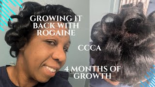 BEATING ALOPECIA AMAZING GROWTH [upl. by Assenab]