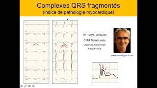 3c Les QRS fragmentés Valeur diagnostique et pronostique P Taboulet [upl. by Oijres255]