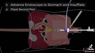 LaparoscopicAssisted Percutaneous Endoscopic Gastrostomy PEG Tube Placement Steps [upl. by Trask944]