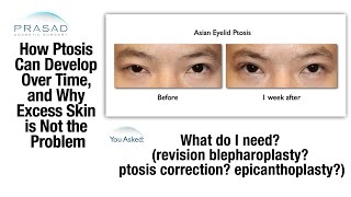 How Ptosis Drooping Eyelid can Develop Over Time and after Previous Double Eyelid Surgery [upl. by Emarej236]