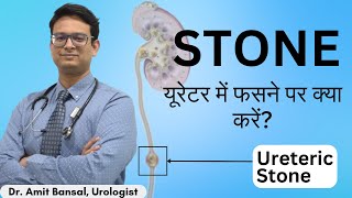 🥶 Ureter में पथरी फस गई  Symptoms and Treatment  Kidney Stone in Ureter II Dr Amit Bansal [upl. by Ssitnerp]