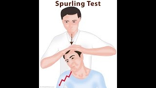 Spurling Test [upl. by Nalod]