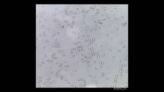 Red blood cells in urine microscopy urine analysis [upl. by Arni]