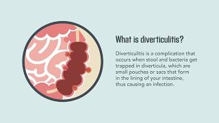 Diverticulitis Signs Symptoms Causes and Treatment  Merck Manual Consumer Version Quick Facts [upl. by Eendyc]