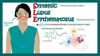 Systemic Lupus Erythematosus  signs and symptoms pathophysiology and diagnosis of Systemic Lupus [upl. by Liamsi]