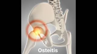 Osteitis inflammation of boneshorts [upl. by Silra502]