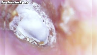 Ear Wax Removal  127 His Earwax Is Infected With White Yeast  Ear Cleaning ASMR [upl. by Rehpetsirhc]