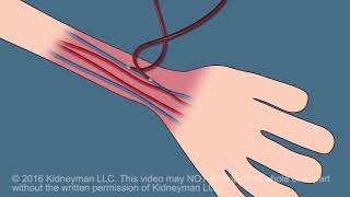 Dialysis Fistula animation [upl. by Tihw]