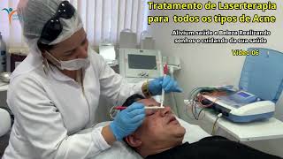 Tratamento de Laserterapia para todos os tipos de Acne [upl. by Amjan658]