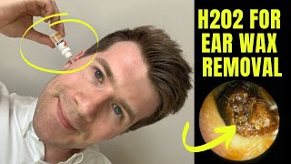 How to remove EAR WAX at home using HYDROGEN PEROXIDE H202 solution  Doctor ODonovan explains [upl. by Ytsrik]