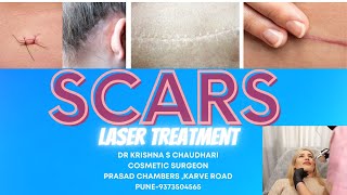 scars managementco2 laser [upl. by Eicart402]