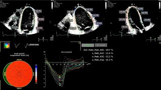 A Practical Guide to Echocardiographic Global Longitudinal Strain GLS by 2D Speckle Tracking [upl. by Ytima718]