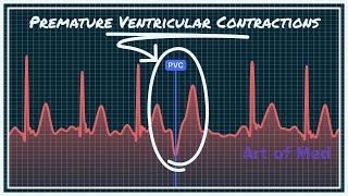 Premature Ventricular Contrcations Ventricular Bigeminy Trigeminy Quadrigeminy [upl. by Aenal]