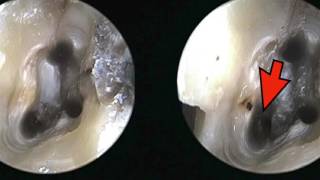 Maxillary Sinusitis of Endodontic Origin A Call to Action Part 2 of 2 [upl. by Haym]